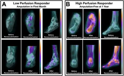 Molecular Imaging of Lower Extremity Peripheral Arterial Disease: An Emerging Field in Nuclear Medicine